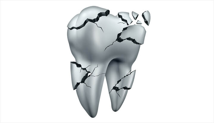 虫歯を放置するリスク
