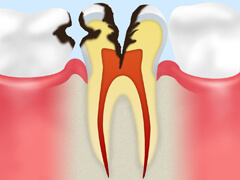 C3：歯の神経にまで達した虫歯
