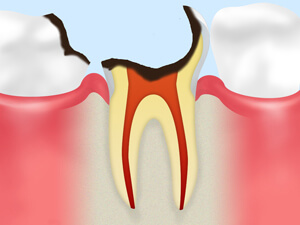 C4：歯根にまで達した虫歯