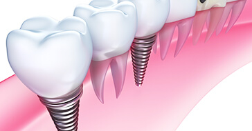 Implant インプラント