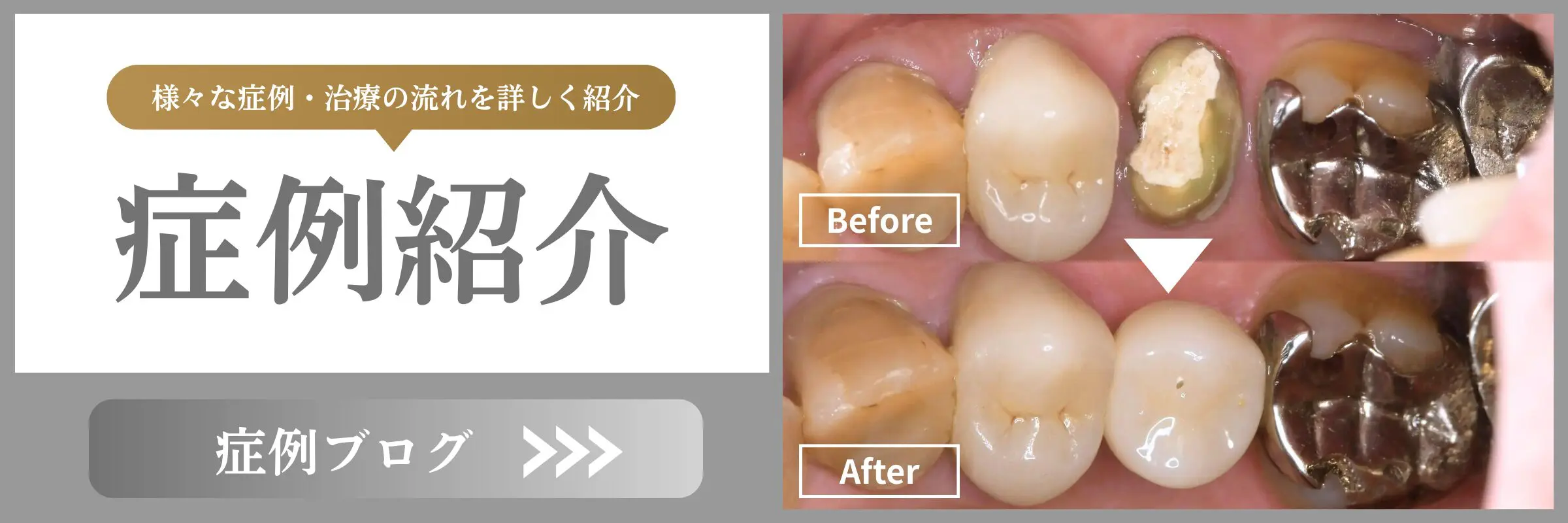 インプラント治療 | 州デンタルオフィス | たまプラーザの歯医者・歯科医院