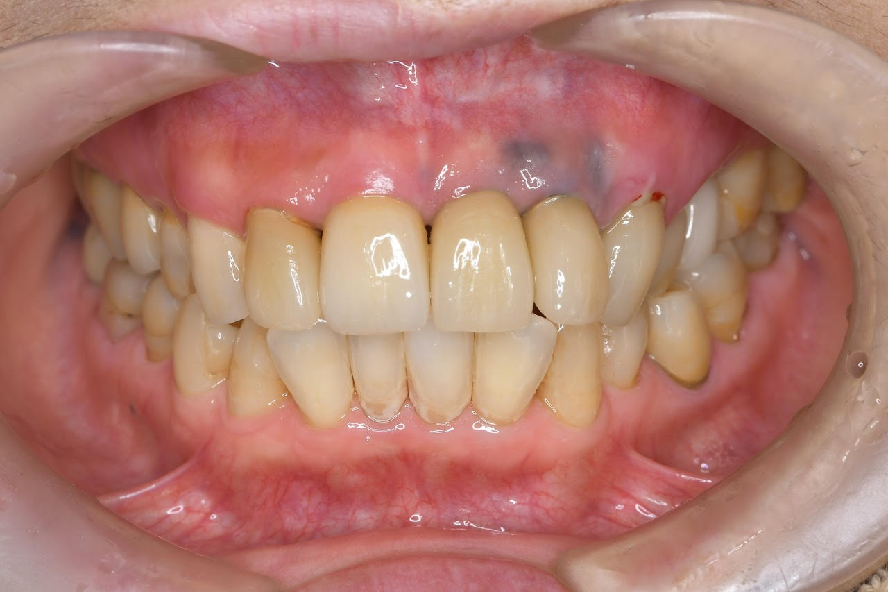 治療終了後画像