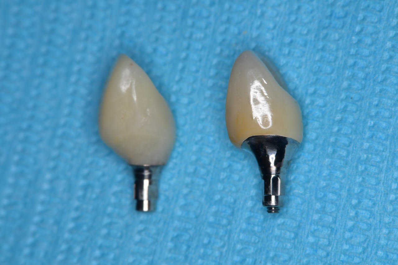 インプラント上部構造