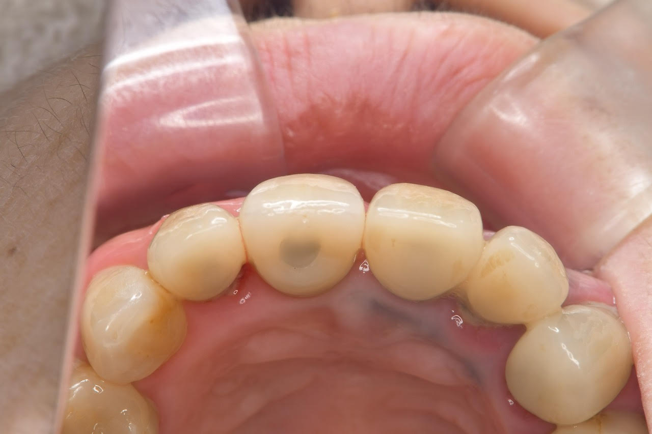 インプラントセット画像